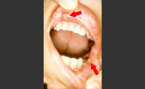 口腔潰瘍（口内炎）の症状の実例写真